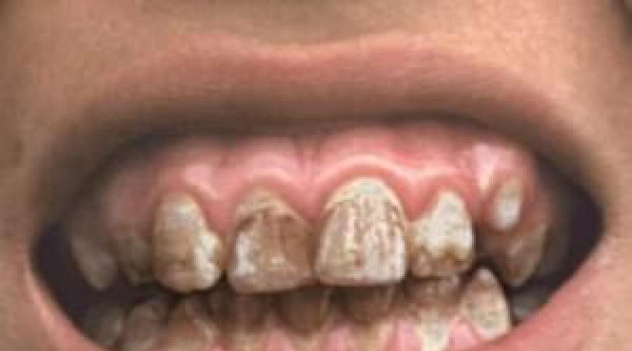 Śnić o zepsutych zębach w sobie.  Jak można interpretować sny o zepsutych zębach?