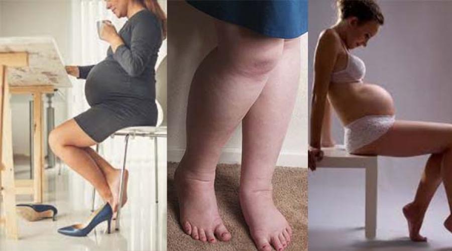 كيفية إزالة التورم عند المرأة الحامل.  سبب الوذمة أثناء الحمل وهل العلاجات الشعبية تساعد؟  لماذا يكون تورم الساق خطيرًا ومتى يجب زيارة الطبيب