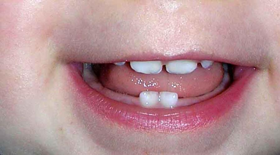 Приснились зубы у ребенка. К чему снятся зубы у младенца